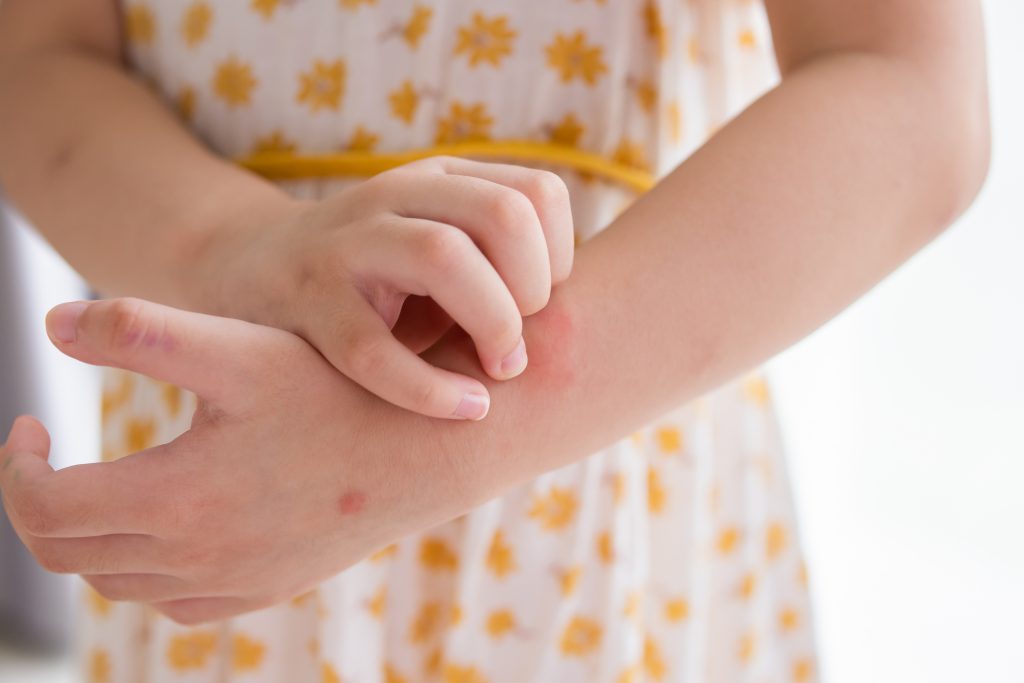 dermatitis atopica en ninos