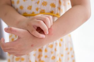 dermatitis atopica en ninos