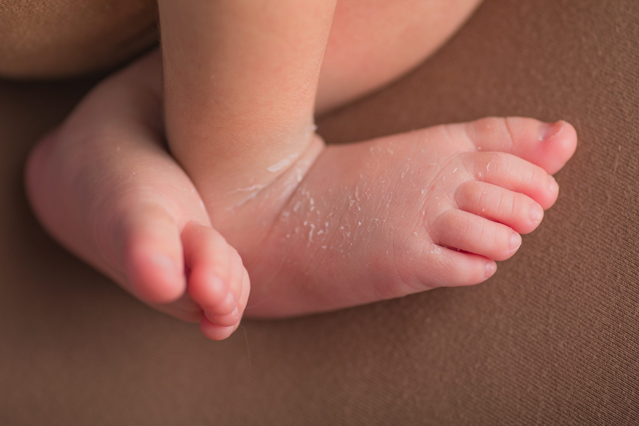 dermatitis seborreica en bebes